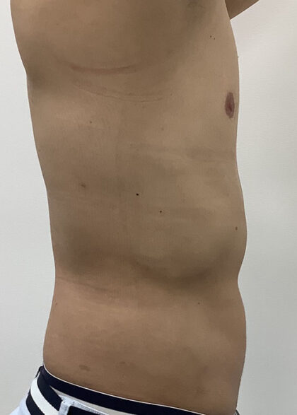 Liposculpture Before & After Patient #1737