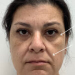 Facial Fillers Before & After Patient #1746