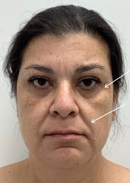 Facial Fillers Before & After Patient #1746