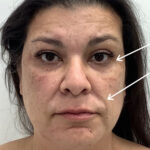 Facial Fillers Before & After Patient #1746