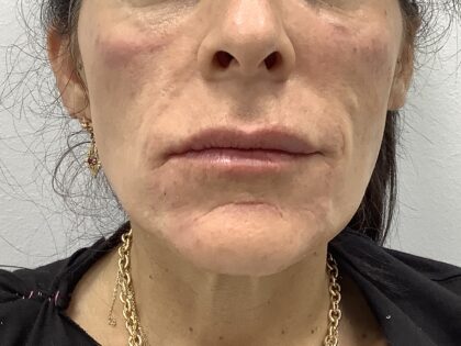 Facial Fillers Before & After Patient #1773