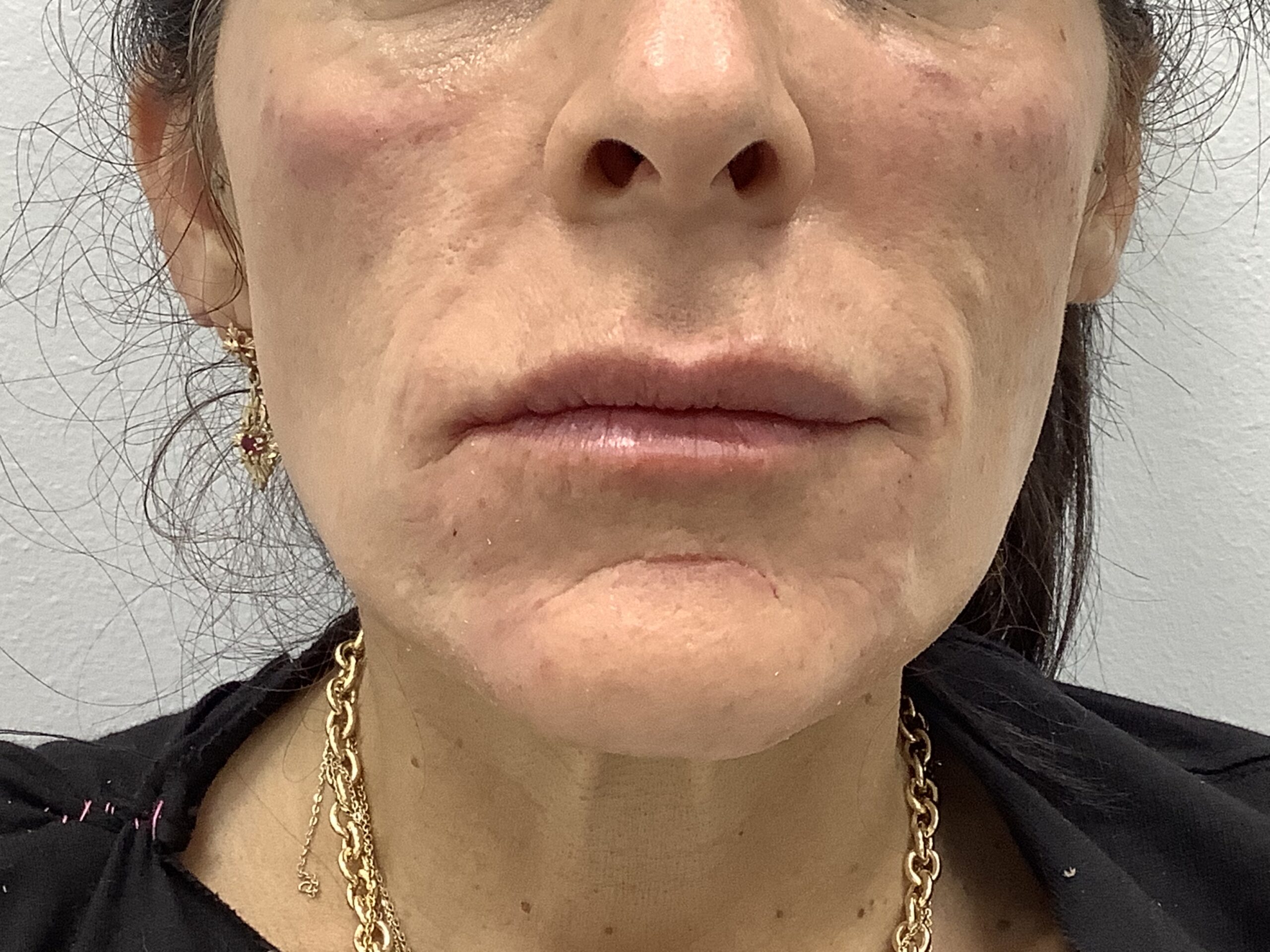Facial Fillers Before & After Patient #1773