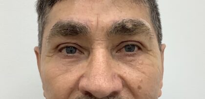 Eye Lift Before & After Patient #1731