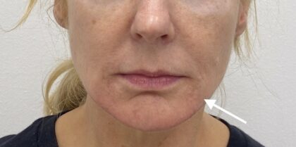 Facial Fillers Before & After Patient #1762