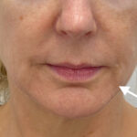 Facial Fillers Before & After Patient #1762