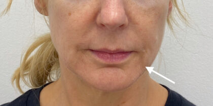 Facial Fillers Before & After Patient #1762