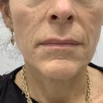 Facial Fillers Before & After Patient #1773