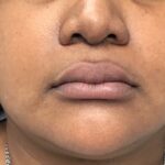 Lip Fillers Before & After Patient #1724