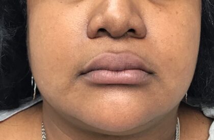 Lip Fillers Before & After Patient #1724