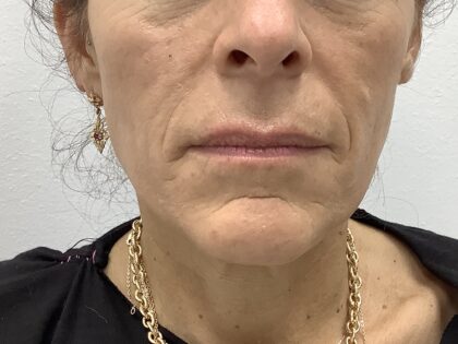 Facial Fillers Before & After Patient #1773