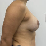 Breast Implant Revision Before & After Patient #1849
