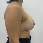 Breast Implant Revision Before & After Patient #1849