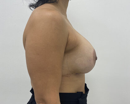 Breast Implant Revision Before & After Patient #1849