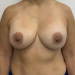 Breast Implant Revision Before & After Patient #1849
