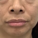 Lip Fillers Before & After Patient #1832