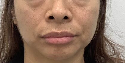 Lip Fillers Before & After Patient #1832