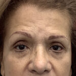 Brow Lift Before & After Patient #1841