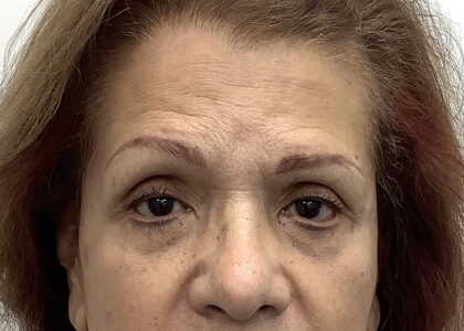 Brow Lift Before & After Patient #1841