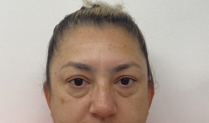 Blepharoplasty Before & After Patient #1854