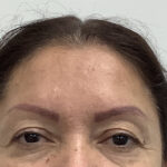 Eye Lift Before & After Patient #1816