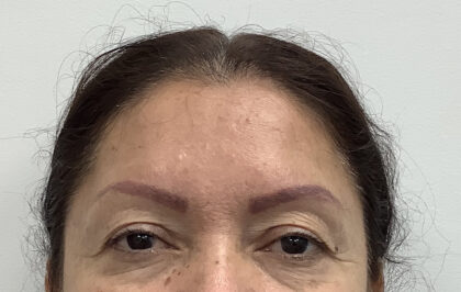 Eye Lift Before & After Patient #1816