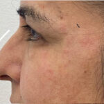 Non-Surgical Rhinoplasty Before & After Patient #1821