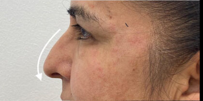 Non-Surgical Rhinoplasty Before & After Patient #1821