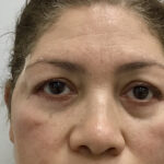 Blepharoplasty Before & After Patient #1829