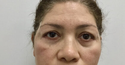 Blepharoplasty Before & After Patient #1829