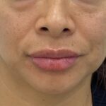 Lip Fillers Before & After Patient #1832