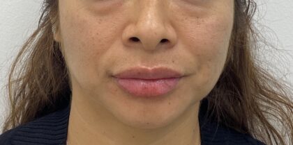 Lip Fillers Before & After Patient #1832