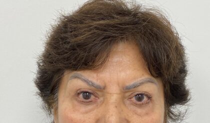 Botox Before & After Patient #1809