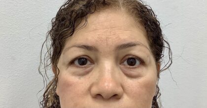 Blepharoplasty Before & After Patient #1829