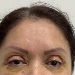 Eye Lift Before & After Patient #1816