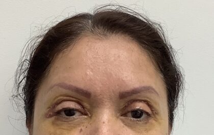 Eye Lift Before & After Patient #1816