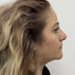 Non-Surgical Rhinoplasty Before & After Patient #1869
