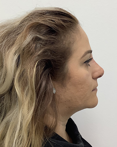 Non-Surgical Rhinoplasty Before & After Patient #1869