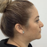 Non-Surgical Rhinoplasty Before & After Patient #1869