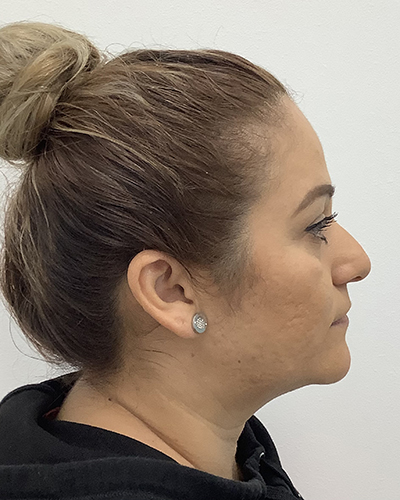 Non-Surgical Rhinoplasty Before & After Patient #1869