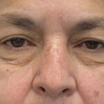 Eye Lift Before & After Patient #1881