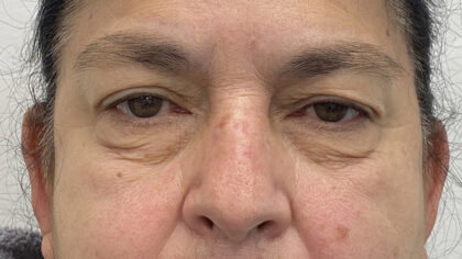 Eye Lift Before & After Patient #1881