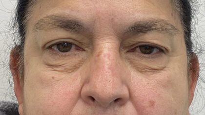 Eye Lift Before & After Patient #1881