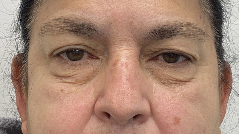 Eye Lift Before & After Patient #1881