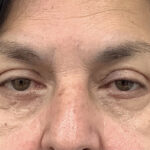 Eye Lift Before & After Patient #1881