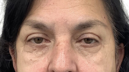 Eye Lift Before & After Patient #1881