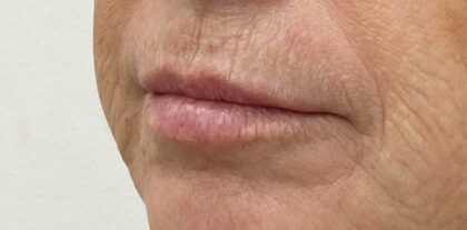 Lip Fillers Before & After Patient #1884