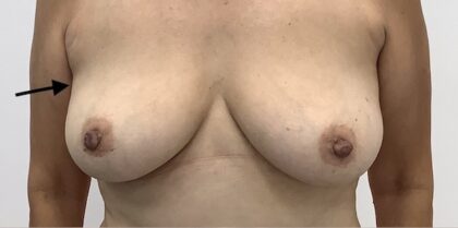 Fat Transfer Before & After Patient #1887