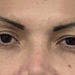 Eye Lift Before & After Patient #1893