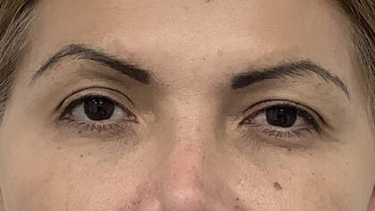 Eye Lift Before & After Patient #1893