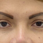 Eye Lift Before & After Patient #1893